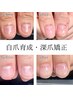1番人気★【初回】自爪育成・深爪矯正 | ￥13090→￥11000| 専用オイル付
