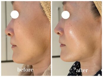 ルー ハナレ 神戸岡本 摂津本山店(Luu HANARE)/小顔 たるみ改善 リフトアップ