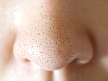 ユー(U)の写真/【毛穴吸引フェイシェル¥5800】美肌は男の身だしなみ!鼻のボツボツ黒ずみ/角栓を大掃除!綺麗な肌で清潔感UP