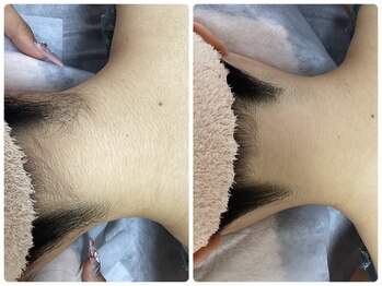 ルルトウキョウ 池袋店(LULU.tokyo)/うなじ脱毛