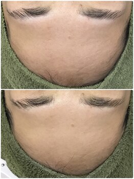 リムーブラボ 藤岡店(Remove Lab.)/口コミ高評価☆ハーブピーリング