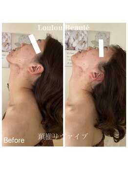 ルルボーテ(Loulou Beaute)/頚椎リヴァイブ