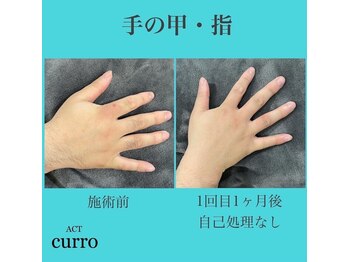 アクト クロ(ACT curro)/【手の甲・指】脱毛施術例