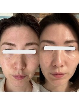 ウイユ(Oeil)/剥けるハーブピーリング 効果2回