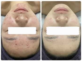 アリュール 京都烏丸御池店(ALLURE)/ハーブピーリング　#ニキビケア