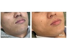 リッカ 学芸大学(RIKKA)/ひげ脱毛