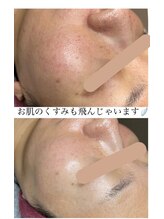 ハナ(HANA)/新メニュープラズマフェイシャル