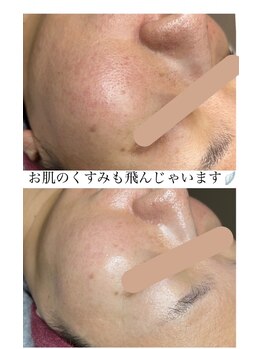 ハナ(HANA)/新メニュープラズマフェイシャル