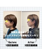 はりん美鍼灸/小顔矯正　横顔　第１弾　2