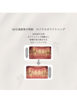 プラスビーセルフ(+b self)/ホワイトニングビフォーアフター