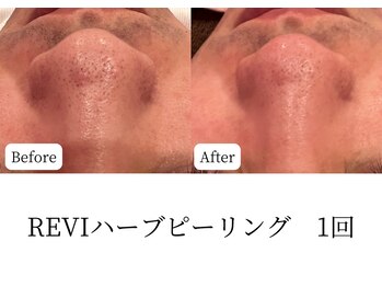 マテオ(Matteo)/しつこい毛穴詰まり!!