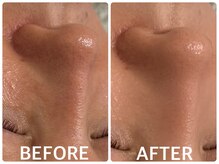 ハーブピーリング 恵比寿/毛穴/角栓/小鼻毛穴