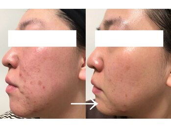 エミナル(eminal)/ビフォー/アフター/ニキビ/本町