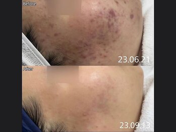 キュライム 熊本(CURAIM)/美肌管理【20代女性】