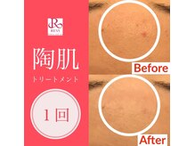 アクアプラス(AQUA+)の雰囲気（アクアプラス人気メニュー！陶肌トリートメントダウンタイムなし）