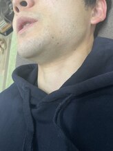 ナノハナ/鹿沼市の全身脱毛のナノハナ