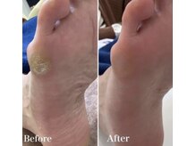 リゼラアンドコー 宇都宮店/ウオノメ、Before＆After！