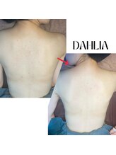 ダリア(Dahlia)/ハーブピーリング【背中】
