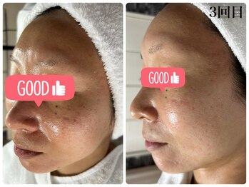 ニュウ(Nyu)/剥離あり☆ハーブピーリング