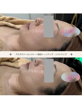 ディアー(Dear)/プラズマパールリフト