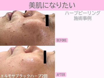 ぷるるんエステ/ハーブピーリング/ピーリング