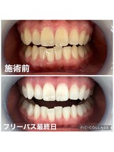 ホワイトニングサロン 京都烏丸店/ホワイトニング施術例