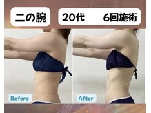 チャルメ/二の腕　6回目