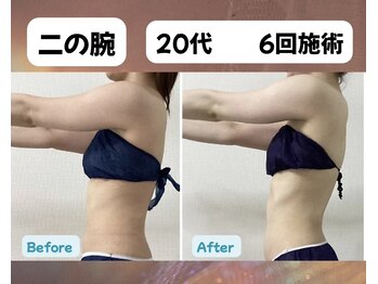 チャルメ/二の腕　6回目