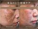 グレイスボディ BiViつくば店(Grace Body)の写真/40代からの肌管理【シミ・くすみ・色素沈着 悩みに】メラセル