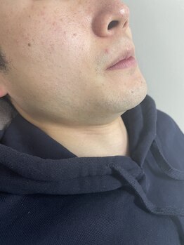 ナノハナ/鹿沼市の全身脱毛のナノハナ