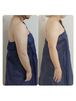 アンティクイーン(Antiqueen)/二の腕スッキリ