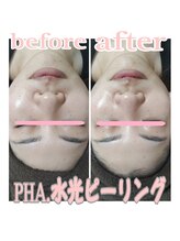 ピュルテ/水光ピーリングトリートメント