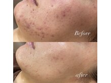 レシェルサロン(Lechelle Salon)/ハーブピーリング＋ダーマエステ