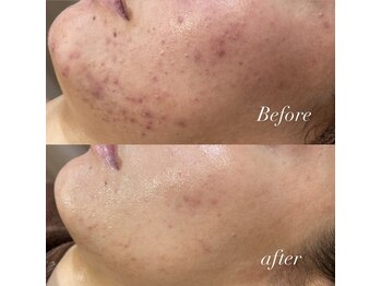 レシェルサロン(Lechelle Salon)/ハーブピーリング+ダーマエステ