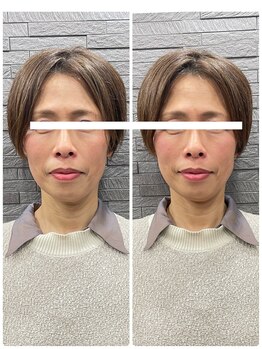 長寿鍼灸院 長寿整骨院/美容鍼50本の効果★小顔効果