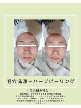 ソワナ(soina)/【神楽坂駅/フェイシャル/毛穴】