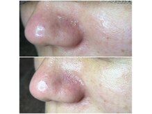 毛穴・脱毛・痩身