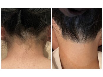 シフォン(Chiffon)/うなじ脱毛