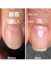 シッカネイル(sicca nail)/ 縦筋、ささくれも