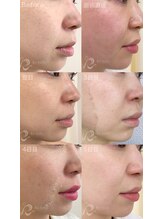 エルビービュティーサロン(LB BEAUTY SALON)/【ニキビ改善】ハーブピーリング