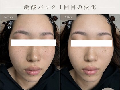 毛穴・肌質改善専門 private salon har’e【ハレ】　ピーリング/小顔の写真