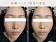 毛穴・肌質改善専門 private salon har’e【ハレ】　ピーリング/小顔の写真