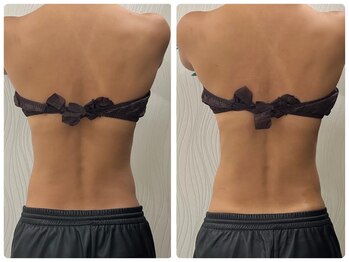 ソルニス(Solnis.)/痩身☆脂肪分解/ハイパーナイフ