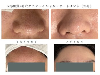 ミシェル(Michelle)/Deep角質/毛穴施術前と施術後