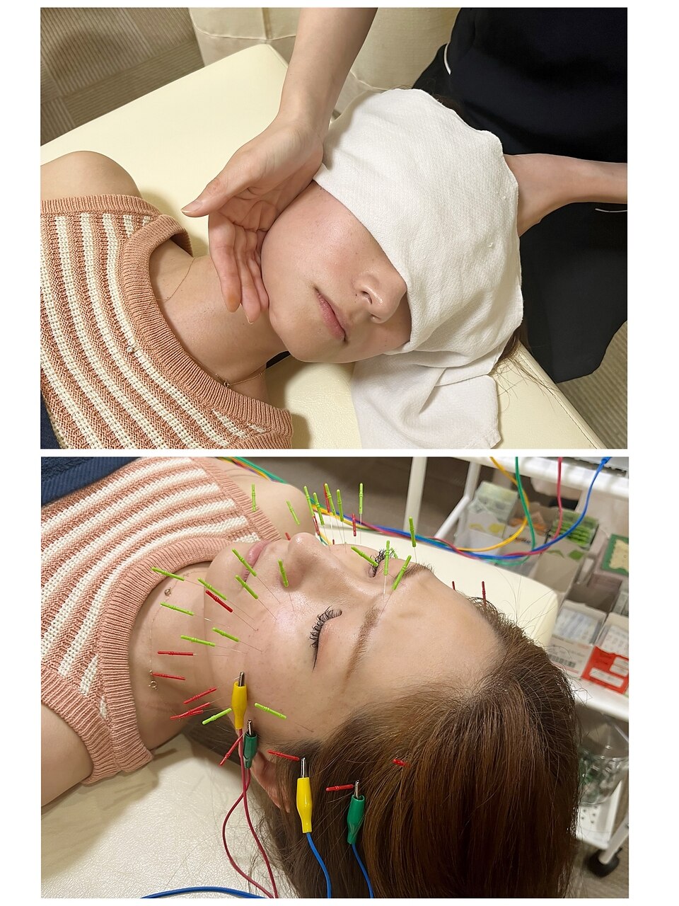 【人気No1!SNSで話題】電気美容鍼＋小顔矯正!!たるみ/むくみ撃退\6200→\4200