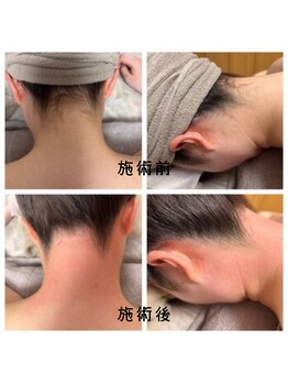 フルールスレーヌ(Fleur Sereine)/シュガーリング&光でダブル脱毛