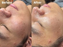 クリスタルビューティ 渋谷/NEW【韓国ミルクスキンピール】