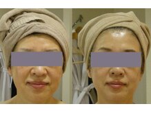 アルマ 芦屋(ALMA)/ここまで変わる！ハーブFA6回♪