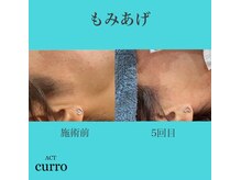 アクト クロ(ACT curro)/【もみあげ】脱毛施術例