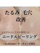 ラ ヴォーテ(La beaute)/マイクロニードルピーリング